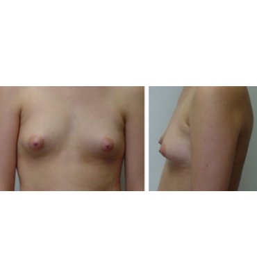 Axillary Breast Augmentation Before
